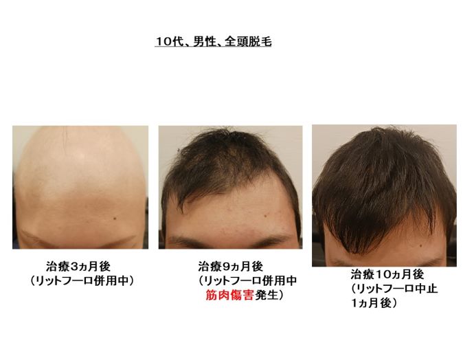 円形脱毛症　病院